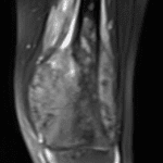 Subsequent MRI in this patient shows a large lesion in the distal femur, with the soft tissue component much more evident than on the radiographs.