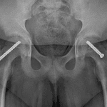 Postop radiograph in this patient. Note that the position of the left femoral head is similar to preoperative radiographs.