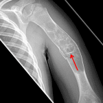 Pathologic fracture of the mid humeral diaphysis through a unicameral bone cyst with a fallen bone fragment (red arrow) within the lesion.