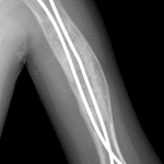 Followup radiographs six months later. The patient was first immobilized to allow fracture healing, then underwent curettage and bone grafting.