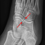 Red arrows: fibrocartilaginous calcaneonavicular coalition.