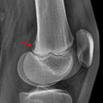 Red arrow: cortical desmoid.