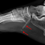 Red arrows: two glass fragments in this patient's foot.