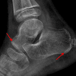 Red arrows: sclerotic bands in the distal talus and plantar posterior calcaneus concerning for stress fractures.