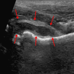 Red arrows: hip effusion and synovial thickening confirmed on the subsequent ultrasound.