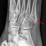 Red arrow: nondisplaced Jones fracture best seen on this oblique view.