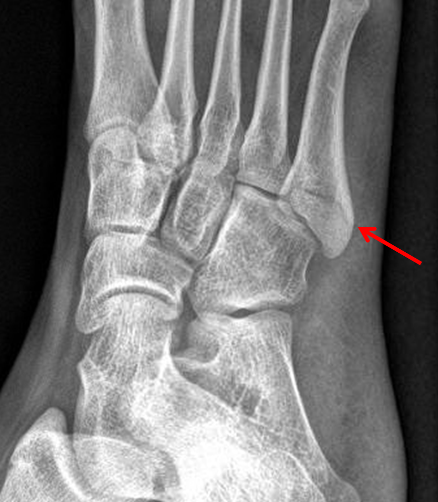 jones fracture