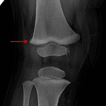 Red arrow: dense metaphyseal band in the distal femur.