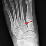 Offset of the medial base of the second metatarsal (red dotted line) from the medial aspect of the middle cuneiform (yellow dotted line). Red arrow: associated avulsion fracture.