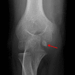 Red arrow: displaced medial epicondyle avulsion fracture.