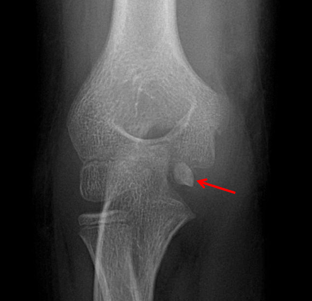 Medial Epicondyle Avulsion Fracture