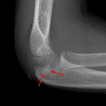 Red arrows: displaced medial epicondyle avulsion fracture.