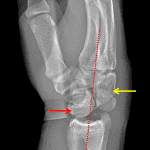 Midcarpal dislocation with volar dislocation of the lunate (red arrow) and dorsal dislocation of the capitate (yellow arrow) relative to a line drawn from the radius to third metacarpal.