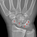 Too many bones in the proximal carpal row due to the scaphoid fracture fragments appearing to be separate bones.