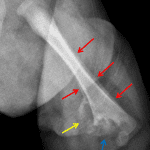 Red arrows: periosteal reaction. Blue arrow: extensive osseous destruction. Yellow arrow: soft tissue extension with heterotopic ossification.