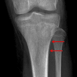 Red arrows: periosteal reaction along the lateral aspect of the proximal tibial metaphysis.