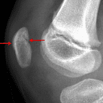 Red arrows: nondisplaced transverse patellar fracture.