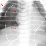 Red arrows: bilateral pneumothoraces. Red dotted oval: note the lucency along and overly clear delineation of the right heart border, which can sometimes be the only sign of pneumothorax.