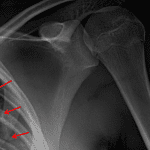 Red arrows: left pneumothorax.