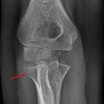 Red arrow: minimally displaced acute radial head fracture.