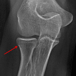 Red arrow: acute nondisplaced radial head fracture.