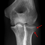 Red arrows: subtle acute nondisplaced radial head fracture.