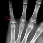 Red arrow: acute nondisplaced Salter II fracture.