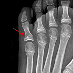 Red arrow: Salter II fracture with associated widening of the medial aspect of the physis.