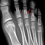 Red arrow: minimally displaced Salter II fracture at the base of the third proximal phalanx.