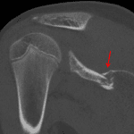 Subsequent CT in this patient confirms a mildly comminuted scapular fracture (red arrow).