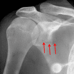 Red arrows: nondisplaced scapular fracture.