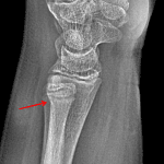 Red arrow: subtle buckle fracture along the dorsal distal radial metaphysis.