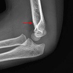 Red arrow: nondisplaced supracondylar humeral fracture.