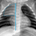 Normal thymus sail sign.