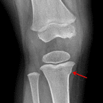 Red arrow: Tibial buckle fracture along the medial aspect of the proximal tibial metaphysis.