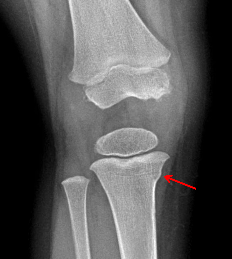 Tibial Metaphysis Fracture