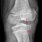 Red arrows: nondisplaced, nondepressed Salter III fracture of the lateral tibial plateau.