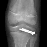 Postop radiograph in this patient.