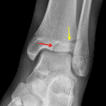 Red arrow: vertical epiphyseal fracture. Yellow arrow: horizontal fracture extension through the lateral physis. Note that the medial aspect of the physis is fused.