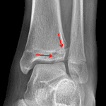 Red arrows: Tillaux fracture.