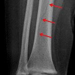 Red arrows: nondisplaced spiral fracture of the distal tibia.
