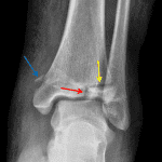 Red arrow: vertical fracture through the epiphysis. Yellow arrow: horizontal fracture through the lateral physis. Note that the medial physis is fused. Blue arrow: chip fracture along the medial malleolus.