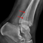 Lateral view shows subtle fracture continuation into the distal tibial metaphysis (red arrows).