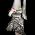 Anterior view 3D reformat from the patient's subsequent CT shows the epiphyseal (red arrow) and physeal (yellow arrow) fracture components.