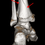 Posterior view 3D reformat from the patient's subsequent CT shows the triangular metaphyseal fracture component.