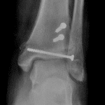 Followup radiographs after ORIF in this patient.