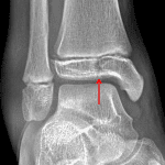 Red arrow: vertical fracture of the distal tibial epiphysis.