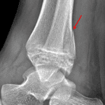 Red arrow: oblique fracture of the distal tibial metaphysis.