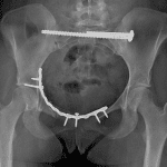 Postop radiograph in this patient.