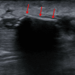 Red arrows: retained wood splinter confirmed on this patient's subsequent ultrasound.
